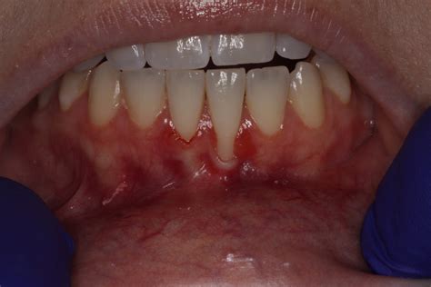 gum grafting surgery henderson nv